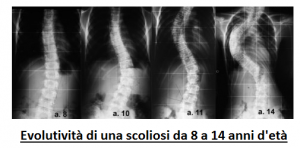 scogliosi evoluzione